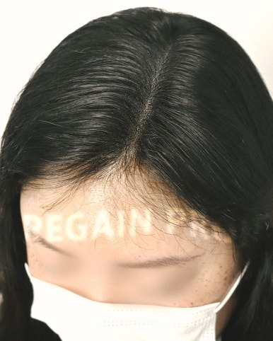 여성 가르마 탈모 시술 후