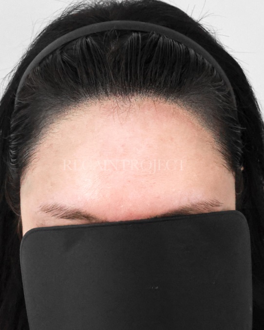 여성 헤어라인 교정 시술 후